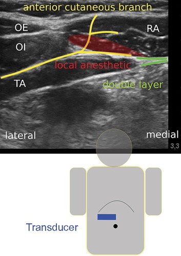 Figure 1 Transducer position, course of the anterior cutaneous branches (yellow) and instillation of local anesthetic (red).