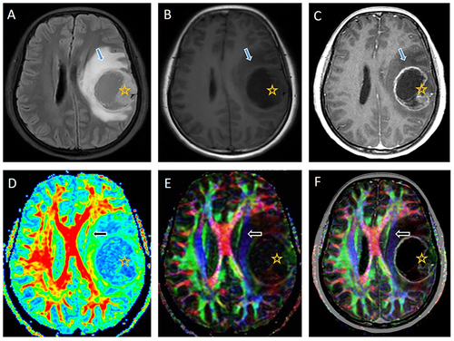 Figure 2 Diffusion tensor imaging of the brain of a 37-year-old woman with a left frontal anaplastic oligodendroglioma (grade III). Axial fluid-attenuated inversion recovery (A), pre-contrast T1-weighted (T1W) (B), and post-contrast T1W (C) images show a heterogeneous tumor (indicated by a star in (A–F) with central necrosis, ring enhancement, and peritumoral infiltration (indicated by blue arrow in (A–C). The tumor appears to infiltrate and medially compress the left corticospinal tract (CST) (indicated by black arrow in (D–F). The combination of the color-coded map and post-contrast T1W (F) shows tumor contact with the left CST, leading to a glioma-to-CST distance of 0 mm.