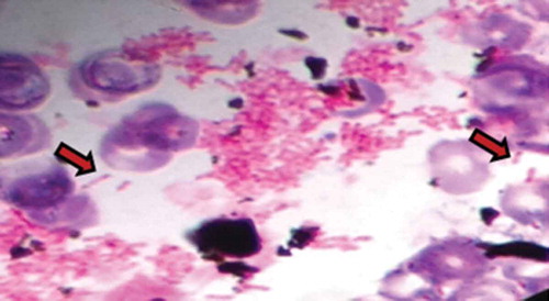 Figure 1. Light microscopy showing characteristic bipolar staining with ‘safety pin’–like appearance.