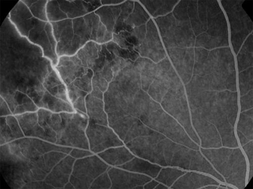 Figure 4 Fluorescein angiography showing inactive TRV. Like Figure 3 (not the same eye), this angiogram shows peripheral capillary non-perfusion in the left upper corner; the blocked fluorescence along the proximal edge of non-perfusion is due to blot hemorrhages and appears darker. Note that the venules draining the capillary dropout are stained, but not leaking: this appearance is suggestive of inactive sheathing, as shown in Figure 3.