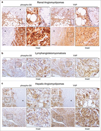 Figure 1. YAP levels correlate with rpS6 phosphorylation in human TSC-related PEComas. Immunohistochemical analysis of rpS6 phosphorylation and YAP expression in human PEComa samples associated with TSC a, renal angiomyolipomas; b, pulmonary lymphangioleiomyomatosis; c, hepatic angiomyolipoma) (N, normal tissue; T, tumor). Scale bar, 100 μm.