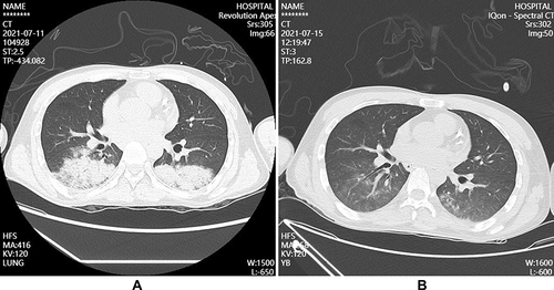 Figure 2 Pulmonary CT after admission.(A) On July 11, infection occurred in the lower lobe of both lungs; (B) After the treatment on July 15, infection in the lower lobe of both lungs were better than before.