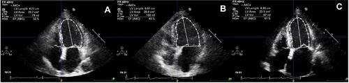 Figure 1 Echocardiographic measurements of left ventricular ejection fraction (LVEF) using the biplane Simpson method. (A) Heart failure with a reduced ejection fraction (HFrEF). (B) Heart failure with a mid-range ejection fraction (HFmrEF). (C) Heart failure with a preserved ejection fraction (HFpEF).