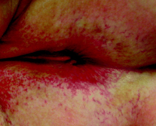 Figure 2.  Perianal telangiectasia in a patient 28 months after definitive chemoradiotherapy with 55.8 Gy (grade 2 late skin reaction according to the LENT/SOMA scale)