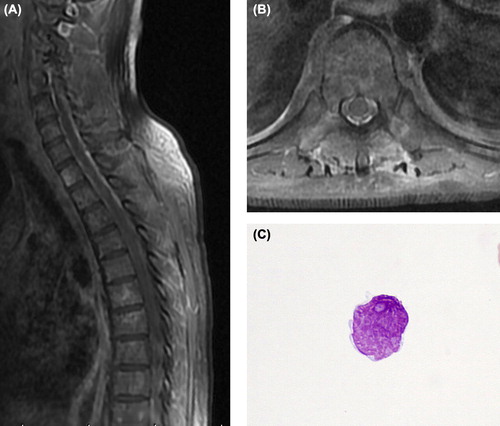 Figure 2. MRI disclosed remarkable enhancement of the meninges in a T1-weighted sequence. (A) Sagittal view section. (B) Axial view section. (C) CSF samples showing lymphoma cells with irregular nuclei with moderately dispersed chromatin and conspicuous nucleoli (May-Giemsa stain, objective magnification 100 ×).