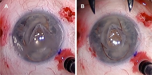 Figure 1 Appearance before (A) and after (B) treatment of calcific band keratopathy with a diamond-dusted burr without ethylenediaminetetraacetic acid.
