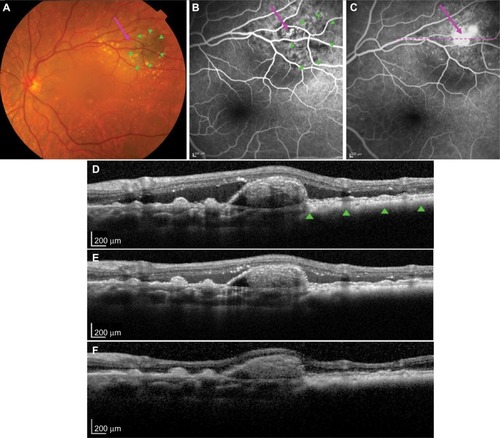 Figure 1 PCV secondary to a stable choroidal nevus.