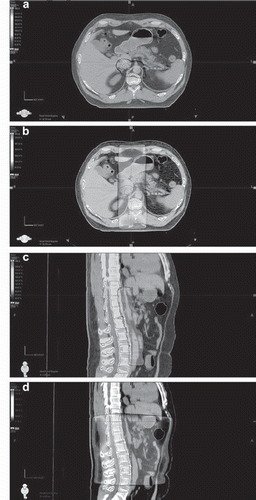 Figure 1. Patient with Stage I testicular seminoma: color wash bone-marrow-sparing intensity-modulated radiotherapy (BMS-IMRT) (a, c) and computed tomography-based traditional radiotherapy (CT-tRT) (b, d) isodose distributions (95% isodose line) on axial (a, b) and sagittal (c, d) views.