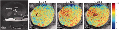 Figure 9. Example of drift in background MR temperatures that may have confounded property determination. The axial T2-weighted fat-saturated image at left identifies the homogeneous desmoid tumour in the lower back. The dashed line indicates the position of coronal magnitude images at three times (t = 2, 12, 22 s) with the temperatures overlaid on the desmoid tumour. Temperature thresholds at ±4 °C have been applied to emphasise changes in background tissue temperatures. Though tissue outside the sonication region (dashed circle) should be unaffected, measurements in some locations drift to cooler and warmer temperatures. These drift patterns continued even after the ultrasound was turned off (not shown).