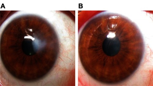 Figure 1 Appearance of case 2 (A) before and (B) six months after surgery.