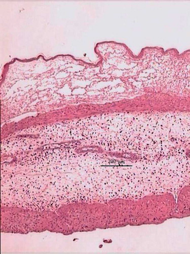 Fig. 3.  Rat fasted for 16 hours, received 2.0 mL of Freon, and was killed 24 hours later. Fore-stomach. Intraepithelial vesicle, edema of the sub-mucosa and inflammatory reaction. H.E.