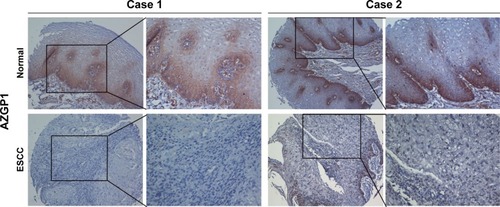 Figure 2 Representative of AZGP1 expression in two pairs of ESCC (below) and adjacent normal tissue (above) were detected by immunostaining with anti-AZGP1 antibody (brown).