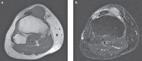 Figure 1. Magnetic resonance images of the tumor at the initial presentation. The tumor showed low signal intensity on T1-weighted images (a) and high signal intensity on fat-suppressed T2-weighted images (b). The tumor was located closely to the patellar tendon, and a part of the tumor crept beneath the tendon. A high signal intensity area, suggesting edema, was seen around the tumor.