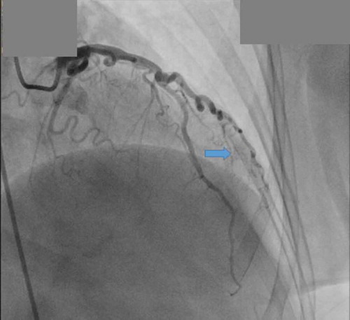 Figure 4. Coronary angiography showing multiple coronary artery microfistulae arising from first diagonal branch of LAD, emptying into the left ventricle (blue arrow).