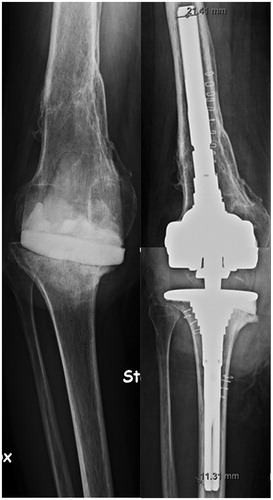 Figure 1. Pre- and postperative radiographs of a 56-year-old man who underwent a 2-stage revision for deep periprosthetic infection for which femoral and tibial metaphyseal sleeves were used at the time of reimplantation.