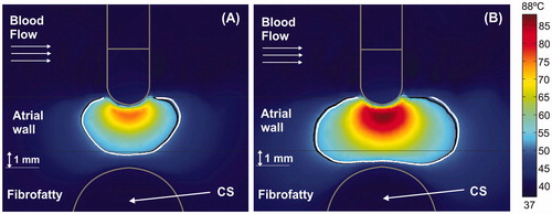 Figure 7. Temperature distributions (scale in °C) with the electrode in perpendicular position for the case of 3.4 mm atrial wall, 1 mm of AW-CS and without occlusion of CS at 15 s (A) and 60 s (B). The cardiac chamber blood flow velocity was increased from 8.5 cm/s (solid black line) to 25 cm/s (solid white line).