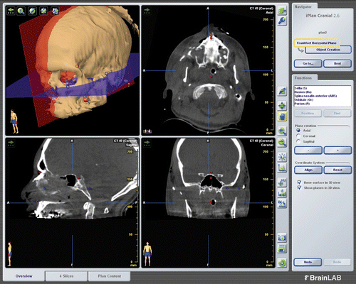 Figure 4. Intra-operative planning. Determination of five anatomical landmarks (the nasion, sella, porion, orbitale and spina nasalis anterior) to define the horizontal Frankfort (blue) and mid-sagittal (red) planes in order to re-align the patient data symmetrically.