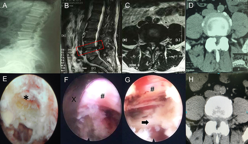 Figure 2 Pre-and postoperative imaging data of a patient in the transforaminal technique group. (A–D) The imaging data shows obvious stenosis of the L4-5 spinal canal. The red box in subfigure B indicates the site of lumbar stenosis. (E) Part of the ventral elements on the superior articular process is removed. Asterisk shows the superior articular process. (F and G) The working channel (X) is well established, after the herniated discs are removed, the ventral side of the nerve root (#) is fully decompressed. A black arrow shows the posterior longitudinal ligament. (H) Postoperative cross-sectional CT shows the spinal canal decompression range is limited.