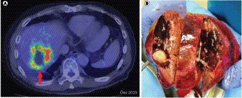 Figure 5. Fused PET-CT axial image demonstrates a larger metabolically active lesion in segment VII/VIII with central necrosis (red arrow) (A) and right hepatectomy specimen (B).