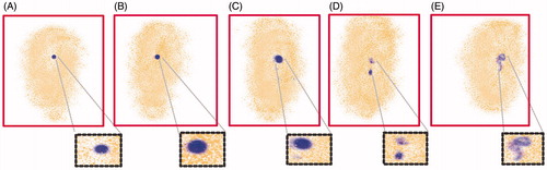 Figure 6. Visualization of release of enteric coated nanoparticulate pellets in various regions of GIT at different time intervals using γ-scintigraphy. (A) Intactness of the pellet was found unaffected in stomach (<2 h). (B) Minimal tracer release in small intestine (<2 h). (C) Release of tracer in ascending colon (after 4 h). (D) Distortion of pellet by releasing the tracer with time as it progresses in ascending colon (9 h). (E) After 12 h, the major amount of tracer release in ascending colon, transverse colon followed by pellet entry into whole colon with complete disintegration (radioactivity in distal part of colon) with increase in time till 24 h. Red color boxes indicate the γ-scintigraphic image of the pellets, where as black dotted boxes highlights the pellets shape with enhanced magnification.