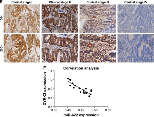 Figure 1 Elevated expression of miR-622 but depressed DYRK2 in colorectal cancer tissue and cell lines. (A) miR-622 expression in 20 cases of CRC tissues with metastasis (mCRC) and 20 cases of CRC tissues without metastasis (nmCRC) was higher than in non-cancerous tissues (nonCRC) as measured by using real time PCR. **P<0.01 vs non-cancerous tissues. (B) The expression of miR-622 was increased in three CRC cell lines (HT29, SW1116, and SW480) compared to normal human colon epithelial cell line NCM460, detected by using real time PCR. **P<0.01 vs NCM460. (C, D) Depressed expression of DYRK2 was shown in CRC tissues (mCRC and nmCRC) compared to non-cancerous tissues (nonCRC) (**P<0.01 vs non-cancerous tissues) and in three CRC cell lines (HT29, SW1116, and SW480) compared to normal human colon epithelial cell line NCM460 (**P<0.01 vs NCM460), detected by using real time PCR and Western blot. All the data are shown as mean ± standard deviation. (E) A gradual decline of DYRK2 expression at four different clinical stages was shown by IHC staining, at two magnifications (100× and 200×). (F) Analysis of correlation between the expression of miR-622 and DYRK2 in CRC tissues (two tailed Pearson’s correlation analysis, r=0.7703, **P<0.01) by detecting the mRNA expression.