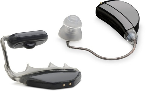 Figure 8 SoundBite™, an in-the-mouth bone-conduction device with implant for tooth attachment and behind-the-ear sound processor.