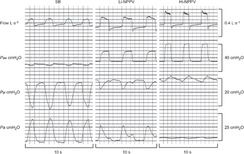 Figure 2. Respiratory mechanical parameters during spontaneous breathing (SB), low-intensity (Li) non-invasive positive pressure ventilation (NPPV) and high-intensity (Hi)-NPPV in a characteristic subject. Paw: airway pressure; Ppl: pleural pressure; Pdi: transdiaphragmatic pressure (published with the kind permission of xxx Citation(27)).