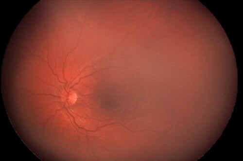Figure 2. Photograph of the fundus of the eye of a patient, age 16 years, with LHON in the acute stage, showing mild hyperemia of the optic disc and tortuosity of the retinal vessels [Citation24].