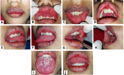 Figure 1 Haemorrhagic crusts on the lips, along with multiple ulcerations on the oral mucosa (A–C, E-H and J); Palatal erythema (D); Pseudomembranous candidiasis can be seen on the patient’s tongue (I).