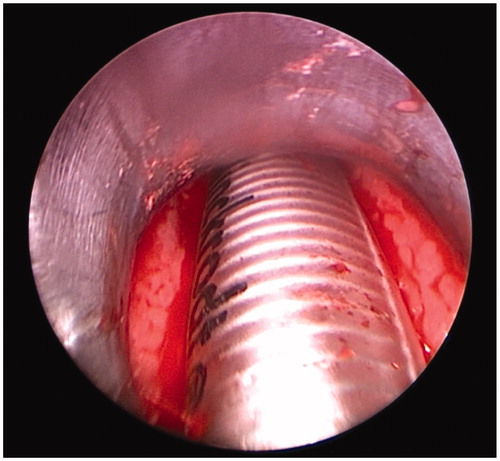 Figure 2. Laryngeal exposure with the conventional suspension laryngoscope (Case No. 5 in Table 1). With the conventional suspension laryngoscope, only the arytenoid area could be viewed microscopically, as grade 3 laryngeal exposure.