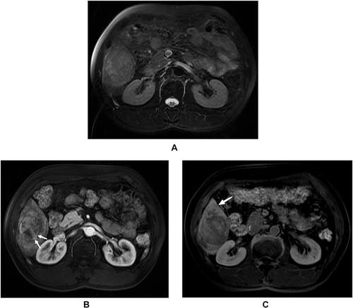 Figure 3 Images of a 54-year-old man with chronic hepatitis B infection, categorized as LR-5 HCC with MVI and recurrence. (A) Heterogeneous mass with mosaic architecture on T2WI; (B) Non-rim arterial phase hyperenhancement (APHE) on the arterial phase, with corona enhancement and internal arteries (white arrow). (C) Peritumoral hypointensity (white arrow) in the hepatobiliary phase.