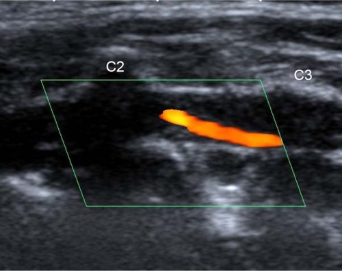 Figure 2 Color flow longitudinal duplex ultrasound highlights the severe luminal narrowing of left intervertebral VA due to intramural hematoma.