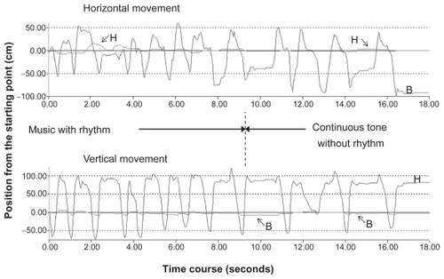 Figure 3 Changes in motion induced by music with and without a rhythm in a 12-year-old patient.