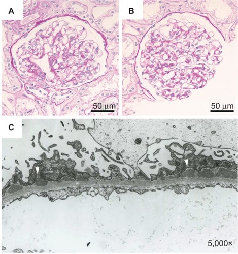 Figure 2 The renal biopsy findings.