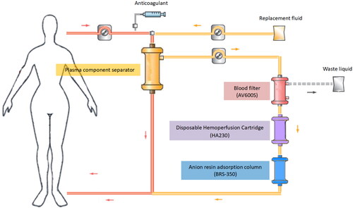 Figure 2. Schematic diagram of FPSA-CVVH treatments. Whole blood was separated by a plasma component separator (EC40W), with the blood flow rate and the plasma separation rate set at 220–250 and 90–100 mL/min, respectively. The separated plasma was filtered through a blood filter (AV600) at an ultrafiltration rate of 66.7 mL/min. Then, the concentrated plasma was added to a disposable hemoperfusion cartridge (HA230) and an anion resin adsorption column (BRS-350) and returned to the body. Bicarbonate replacement fluid at a speed of 4000 mL/h in predilution mode was added synchronously before EC40W.