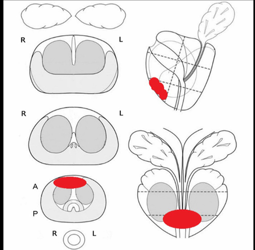 Figure 3 Schematic of the prostate lesion (red shading highlights the location of the lesion within the prostate gland).
