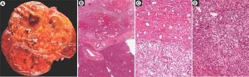 Figure 2. Hepatocellular carcinoma developed in a patient with NAFLD.(A) Macroscopic view showing a large heterogeneous tumor nodule with firm brown and soft yellowish areas. Histological analysis showing (B) at low magnification an encapsulated tumor arising in a normal liver, (C & D) different microscopic patterns (architectural and cytological) are observed throughout the tumor.NAFLD: Non-alcoholic fatty liver disease.