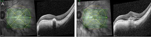 Figure 5 OCT-scans with an ETDRS grid overlay centered on the fovea of the same eye at an inactive visit (A) with a subfoveal mCNV with sharp borders and no intra- or subretinal fluid as opposed to an active visit (B) with fuzzy borders and subretinal fluid. MCNV activity was graded in the central 1 mm, 3 mm and 6 mm of the overlayed ETDRS ring.