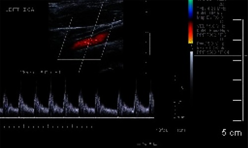 Figure 3 Doppler imaging of recanalization of ICA.