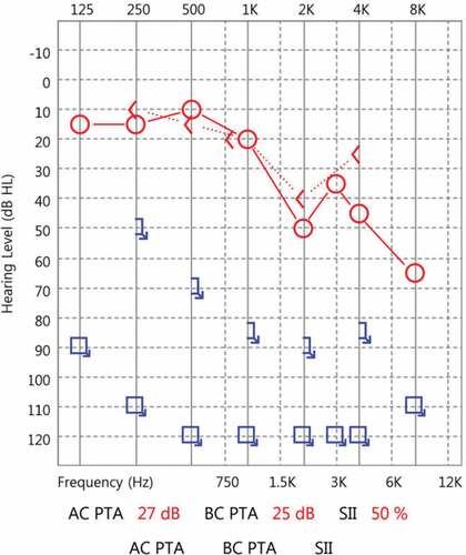 Figure 1. Initial hearing threshold with a weighted four-frequency average ([500 Hz +1000 Hz × 2 + 2000 Hz × 2 + 4000 Hz]/6) on pure tone audiometry was 32 dB in the right ear and indicated deafness in the left ear.