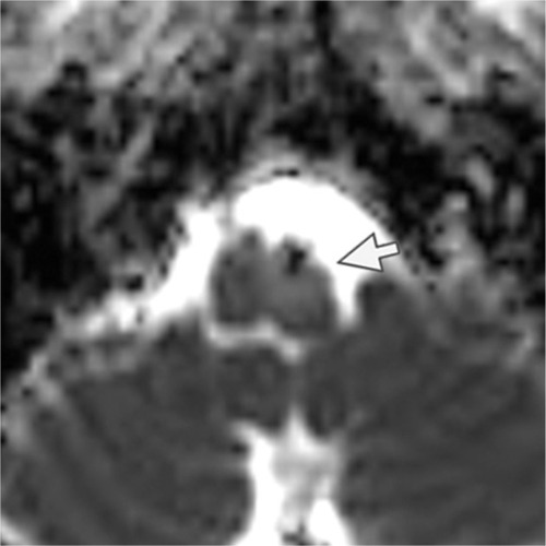 Figure 3 MRI of the brain. ADC image shows increased diffusion at the left medulla (arrow).