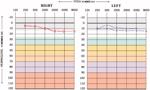 Figure 1. Pre-medication audiogram of case 1.