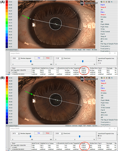 Figure 4 Ocular sagittal height at 11.20 mm chord, shown by the white cross close to the limbus on image (A), and at 10.00mm with the cross moving inside the corneal area (B). The green arrow indicates the position of the white cross in both figures.