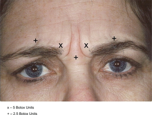 Figure 1 Recommendations for injection (Botox).