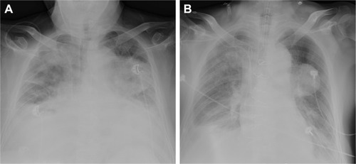 Figure 1 Preoperative and postoperative chest X-ray of the patient.