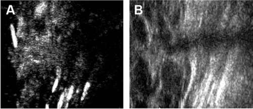 Figure 1 Contrast-enhanced ultrasound images in the case (A) and control groups (B).
