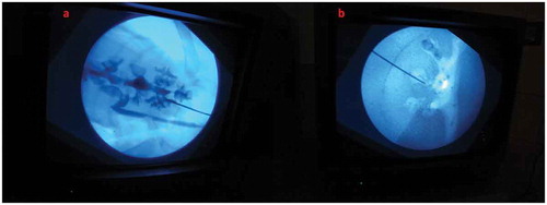 Figure 7. Fluoroscopic view of puncture in: (a) Biological model and (b) Non-biological model.