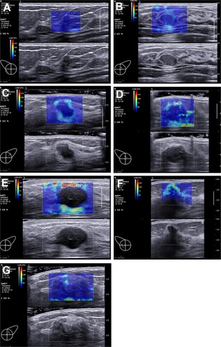 Figure 1 Seven patterns could be demonstrated on the images acquired in ShearWave™ Elastography (SWE).Notes: (A) No findings: No difference is observed at the margin of or inside the lesion with the color around the lesion (homogeneously blue). (B) Vertical stripes pattern: A color is observed at the margin of or inside the lesion, which differs from the color around the lesion. The differing color extends beyond the lesion and continues vertically in cords on the cutaneous side and/or the thoracic wall. (C) Rim of stiffness pattern: A localized colored area appears at the margin of the lesion and creates a continuous closed circle. (D) Colored lesion pattern: Colored areas are heterogeneously visible inside the lesion. (E) Void center pattern: There is a lack of SWE signal inside the lesion. The rest of the SWE Box fills correctly. (F) Horseshoe pattern: A localized colored area appears at the margin of the lesion and creates an open circle. (G) Spots pattern: Colored areas are visible above and/or below the lesion.