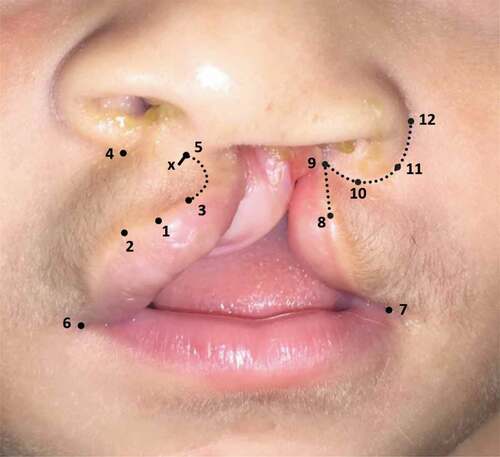 Figure 2. Lip markings of Millard’s technique