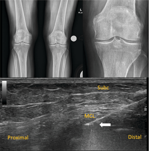 Figure 2. Standing weight bearing anterior to posterior (AP) radiographs of the knee 2 week-post procedure.Plain radiographs AP from the 2 week-post procedure appointment showing resolution of the calcification at the medial femoral condyle with persisting lateral compartment chondrocalcinosis and mild osteoarthritis (upper panel). Ultrasound examination in long-axis to the medial collateral ligament during the TenJet™ procedure showing the needle tip (white arrow) penetrating the calcium within the MCL with decreased lucency of the calcium and reduction in size of the calcium (lower panel).MCL: Medial collateral ligament; Subc: Subcutaneous tissue.